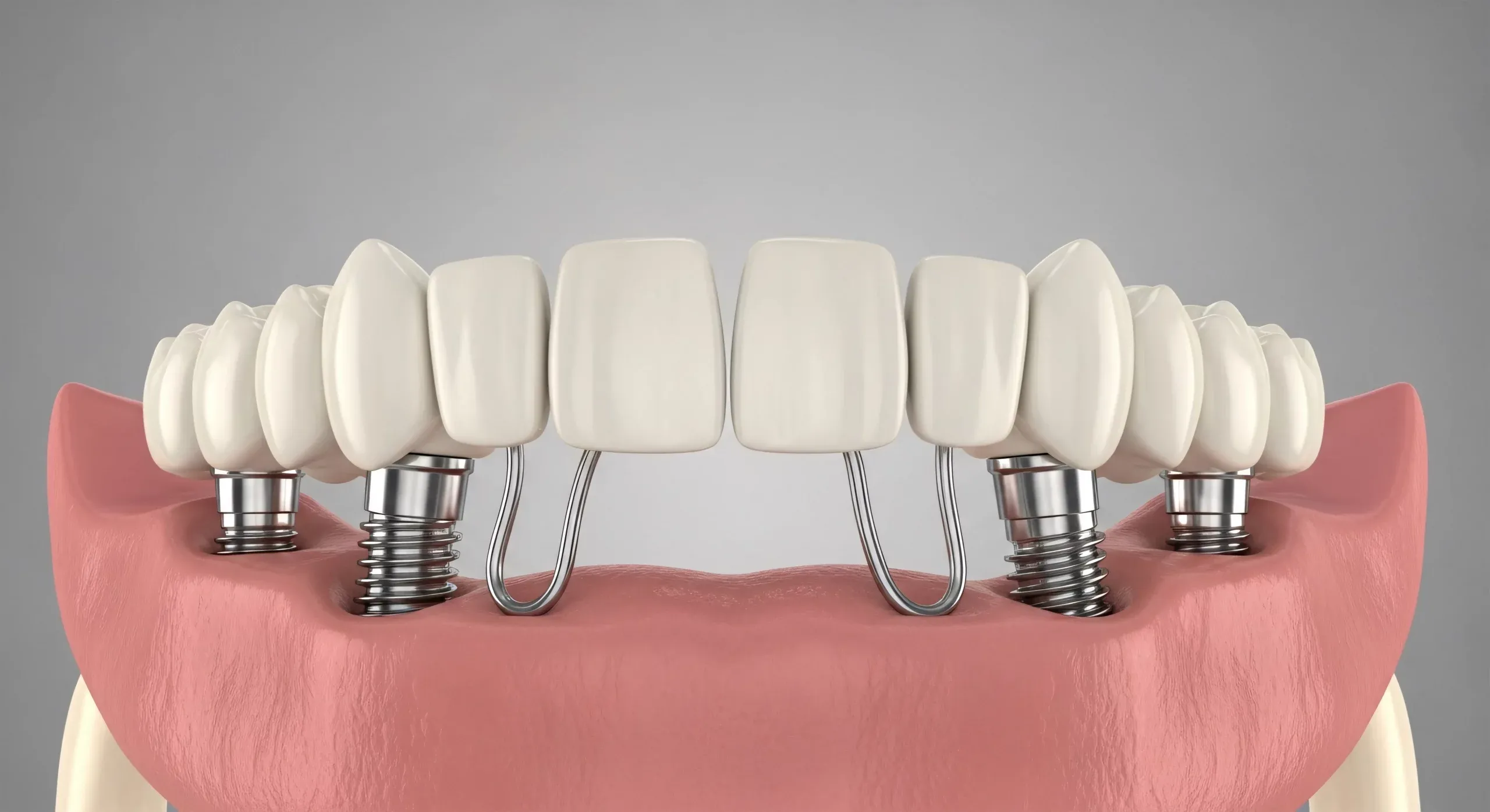 all-on-4-implantat-modell