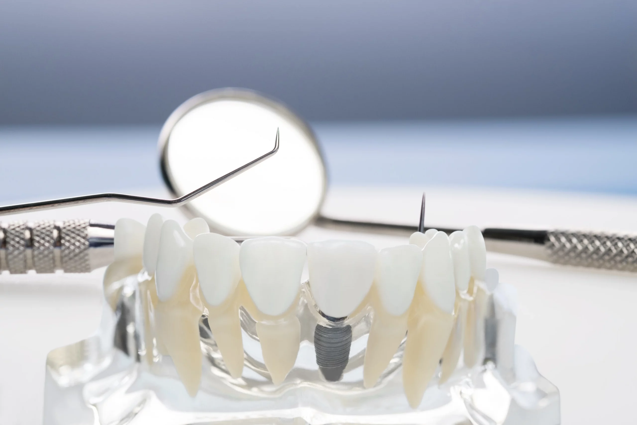 zahn-modell-mit-keramikimplantate