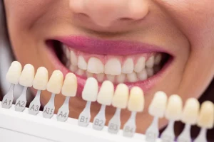 nahaufnahm-frau-mit-veneers