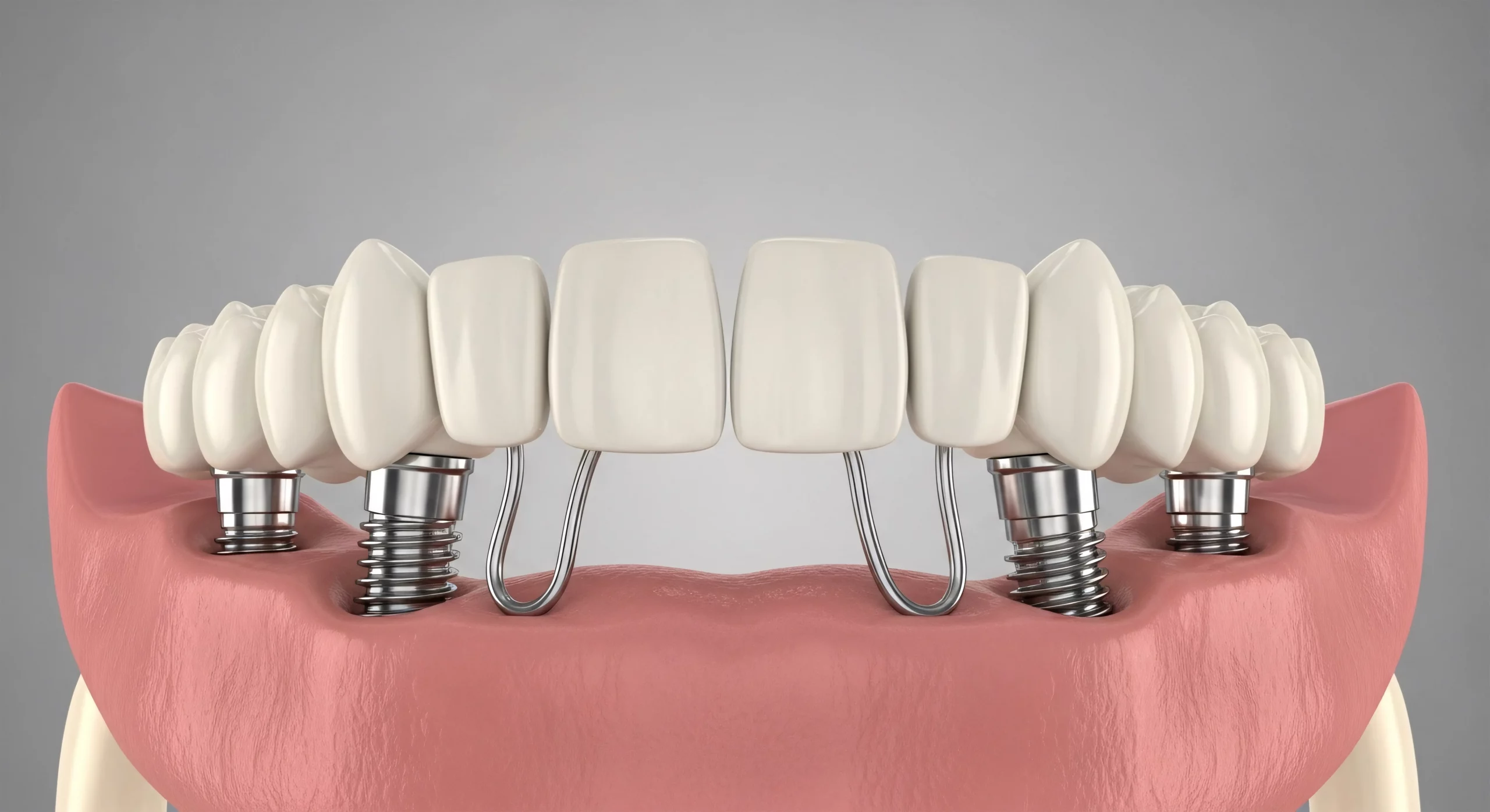 all-on-4-implantat-modell