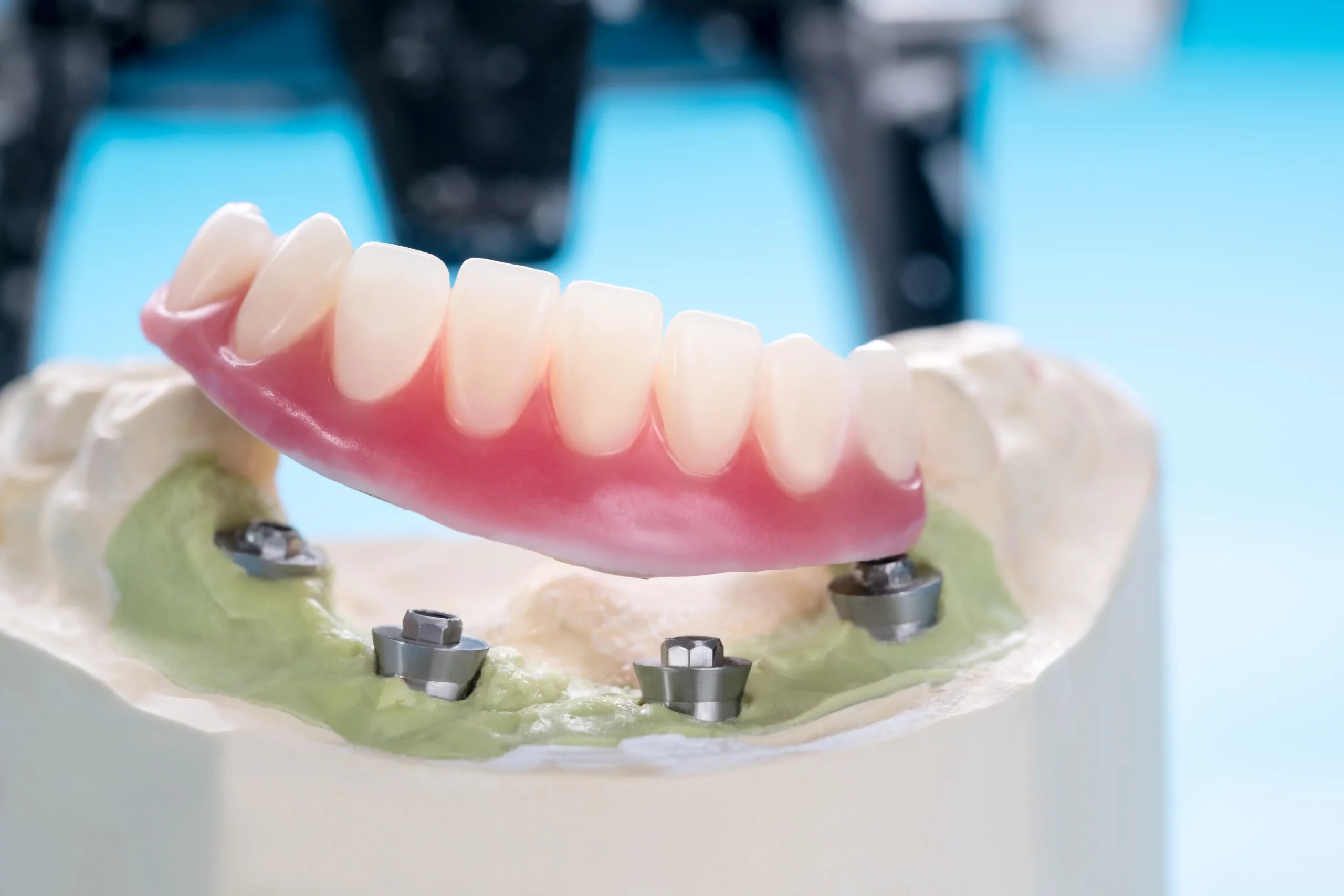 all-on-4-implantat-modell